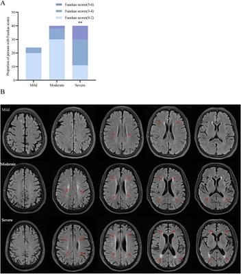 The clinical and neuropsychological profiles of Alzheimer’s disease with white matter hyperintensity in North China